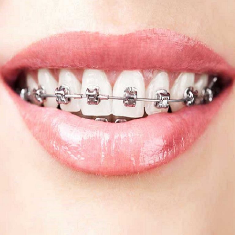 Orthodontics – Dr. Pol's SmileLine Dental